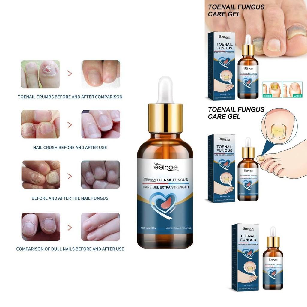 Eelhoe Toenail Care Gel For Yellow Thickened Nails With Fortifying And Restorative Formula