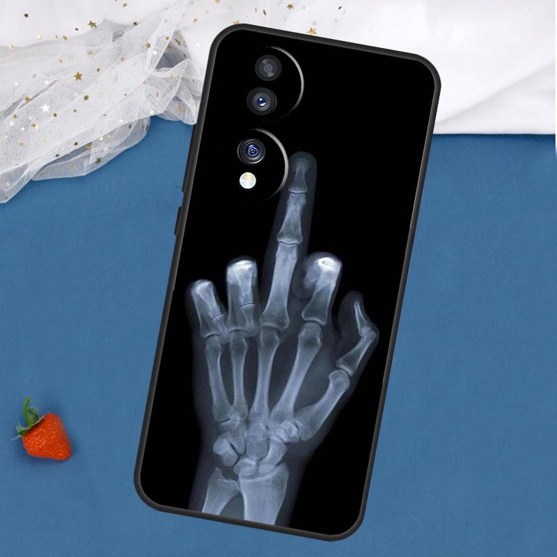 Skeleton Middle Finger Case For Honor Magic 7 5 6 Pro Lite Honor 200 400 50 70 90 X8 X9 X8a X8b X9a X9b X9c Cover