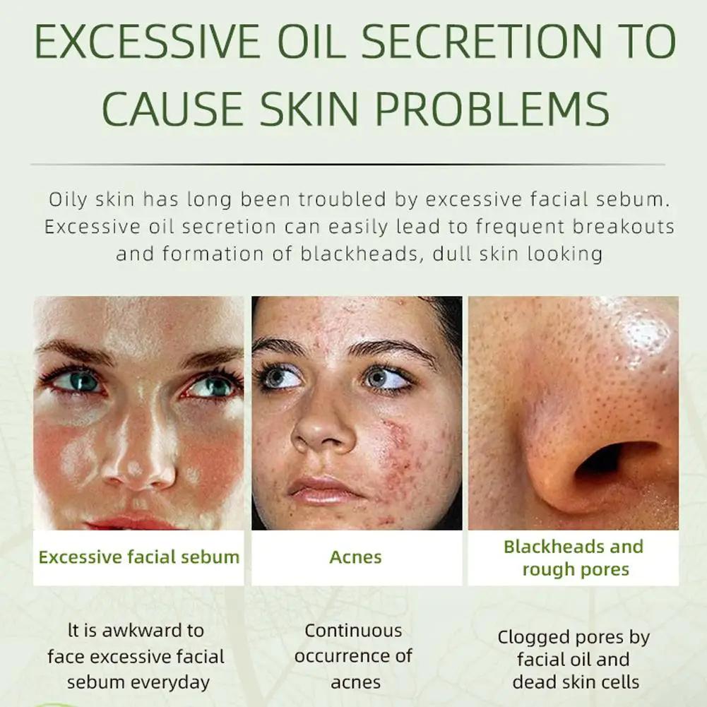 Crème anti-acné pour le visage, élimine les pores dilatés, traite l'acné, contrôle du sébum, réduit les pores, crème pour le visage, soins de la peau, beauté et santé