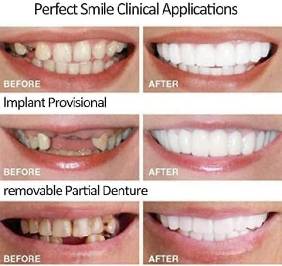 Silicone False Temporary Chipped Emergency Natural and Comfortable Cover Imperfect Instantly Smile with Confidence Dentures, Teeth, Teeth, Teeth, Fix,