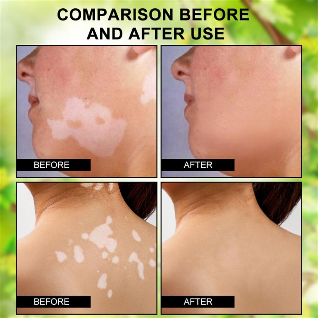 Krém na vitiligo, Přírodní zmírnění vitiliga pro kožní vitiligo, Krém pro péči o vitiligo, Redukuje bílé skvrny a zlepšuje pigmentaci kůže, Snadné použití