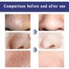 Cerotti per la rimozione dei punti neri, pulizia profonda, trattamento per acne e brufoli, punti neri, restringimento dei pori, rassodanti, leviganti, strisce per i pori del naso, 6 pezzi