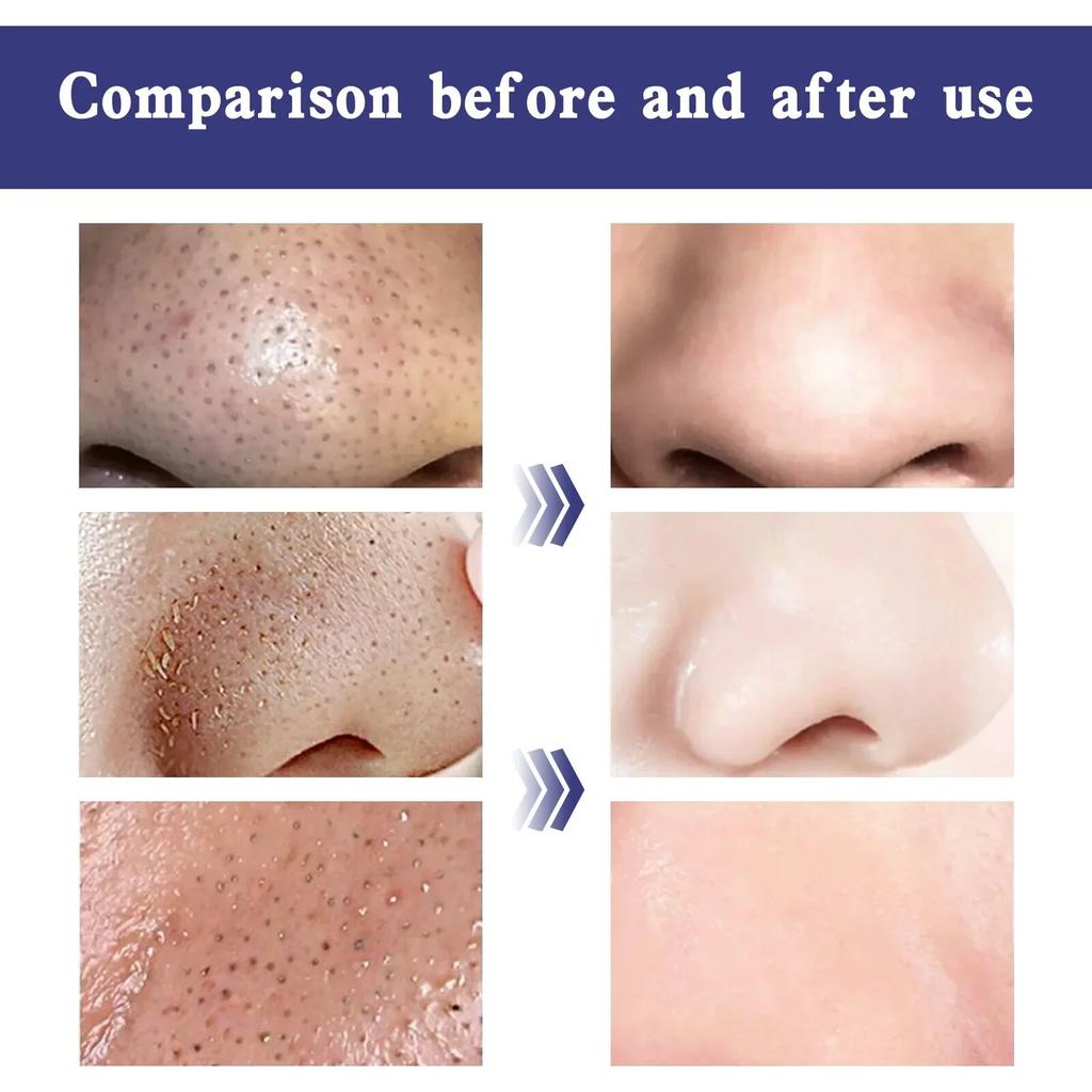 Cerotti per la rimozione dei punti neri, pulizia profonda, trattamento per acne e brufoli, punti neri, restringimento dei pori, rassodanti, leviganti, strisce per i pori del naso, 6 pezzi