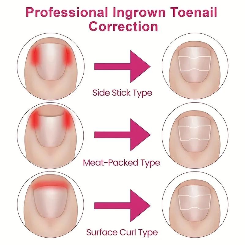20Pcs Nail Correction Stickers Ingrown Toenail Corrector Patches Paronychia Treatment Recover Corrector Pedicure Tools