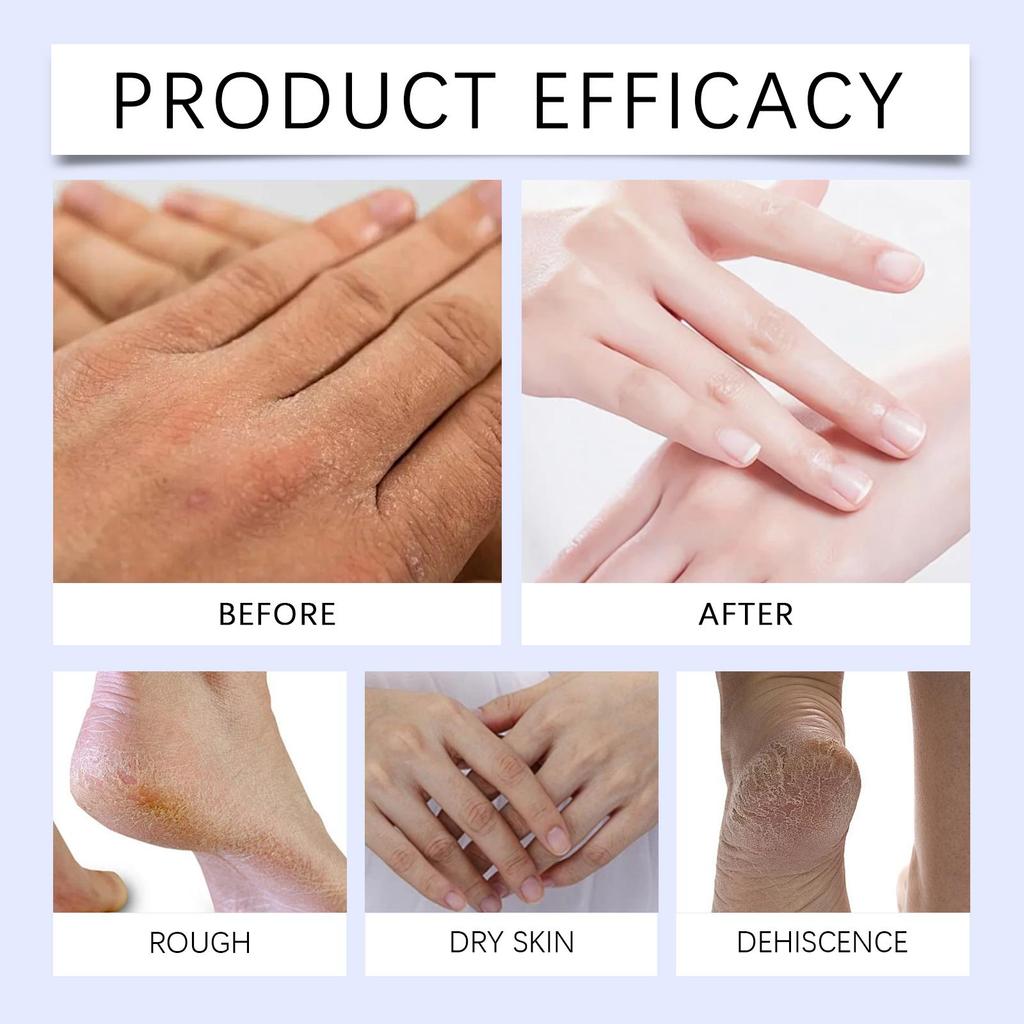 Ximonth Hand & Foot Cream 50g, Natural Formula, Softens Calluses, Moisturizes and Nourishes Hands and Feet