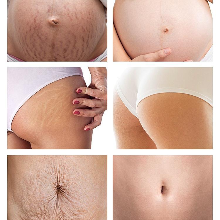 Natural Organic Anti Scar Skin Care Repair Treatment Cream Wrinkle Repair Moisturizing Cream