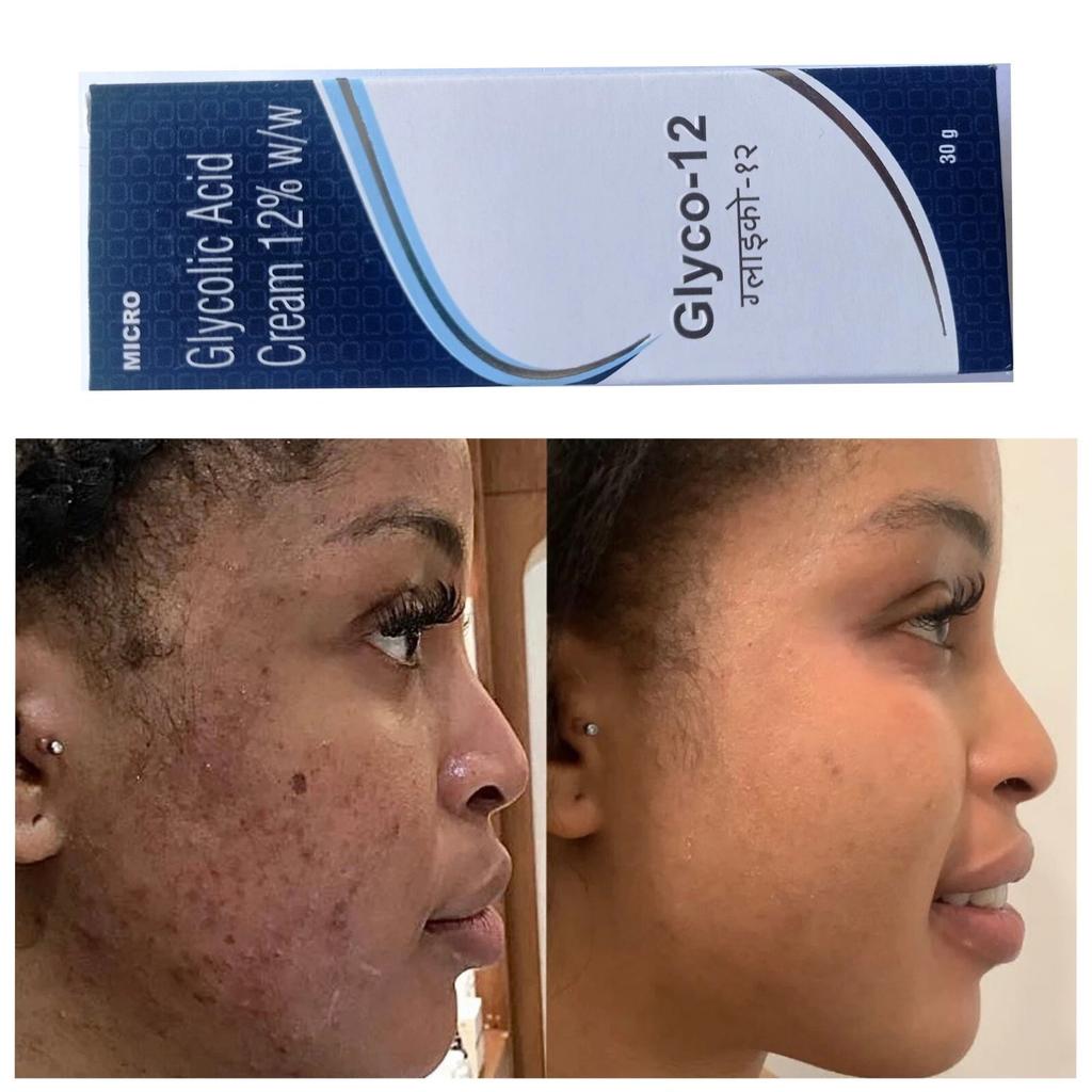 GLYCO 12 Glycolic Acid CREAM 12% Reduce Wrinkles Prevents Acne 30gm