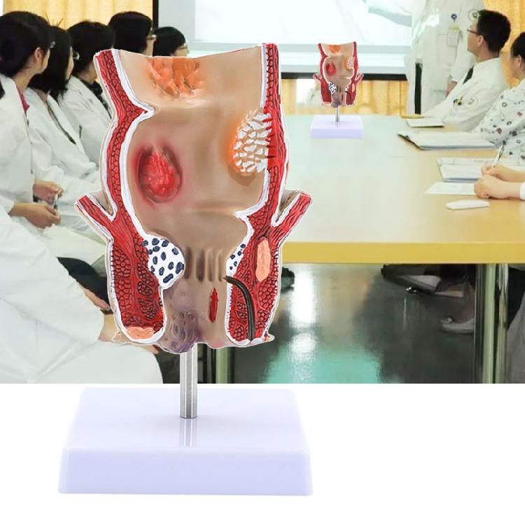 Modèle Anatomique Humain Modèle de Rectum Humain Modèle des Pathologies du Rectum Humain Support Pédagogique pour l'Éducation Scientifique