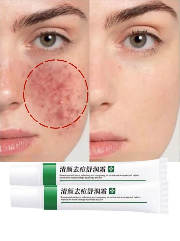 Krém na odstranění akné Krém na pihy Stahování pórů Bělení hydratačního oleje pro kontrolu akné Krém na pleť Péče o pleť Krém proti akné