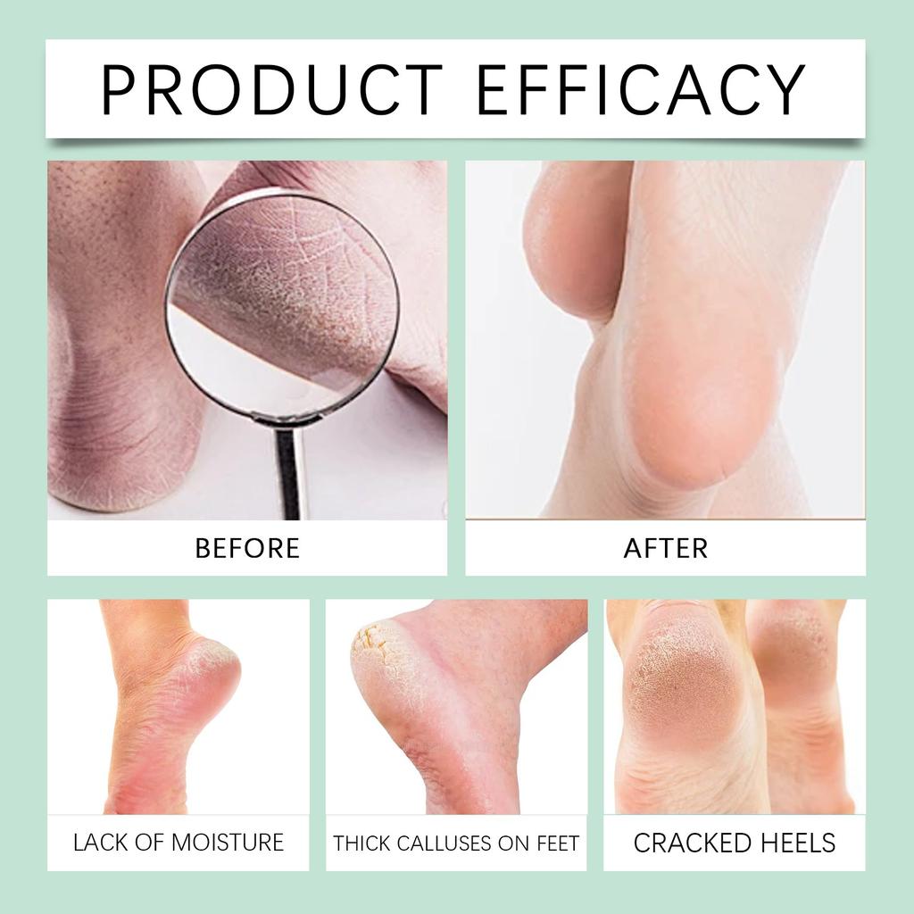 Urea Cream 40% SalicylicAcid, Moisturising Cream Against Cracked Heels, Enriched With & Hyaluronic Acid&AloeVera Extracts, Deep Moisturising