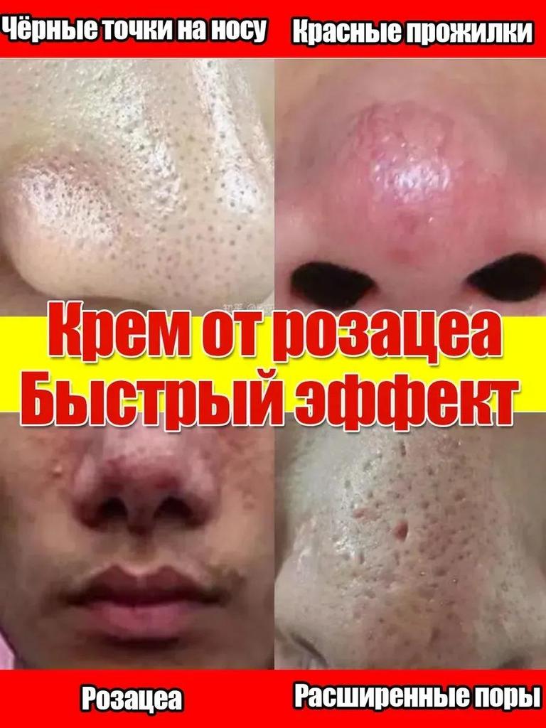 Spezialpflaster für Rosacea rote Nase Erdbeernase