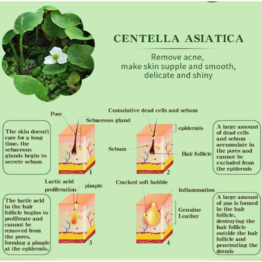 Salvia Acne Treatment Cream Removal Face Blackhead Anti Acne Cream Oil Control Shrink Pores