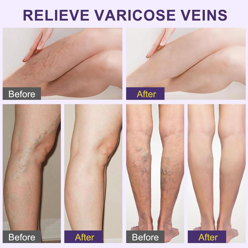 Varicose Veins Cream-Relief Phlebitis Angiitis-Promote Blood Circulation-Repair Skin Elasticity-Suitable For All Skin Types, 20g