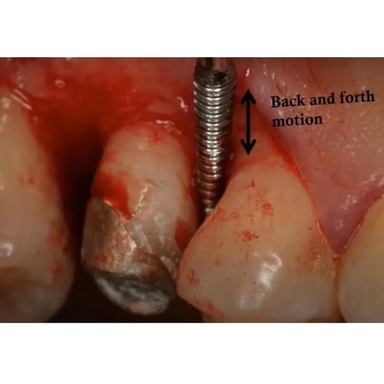 GDC Sugarman Bone File 6 (Fs1/2s)
