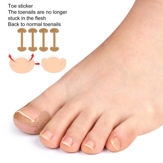 1 Set Nageleinsteller Pediküre-Werkzeug Premium Professional Eingewachsene Zehennägel Fußkorrekturaufkleber Eingewachsene Zehennägel Korrektur