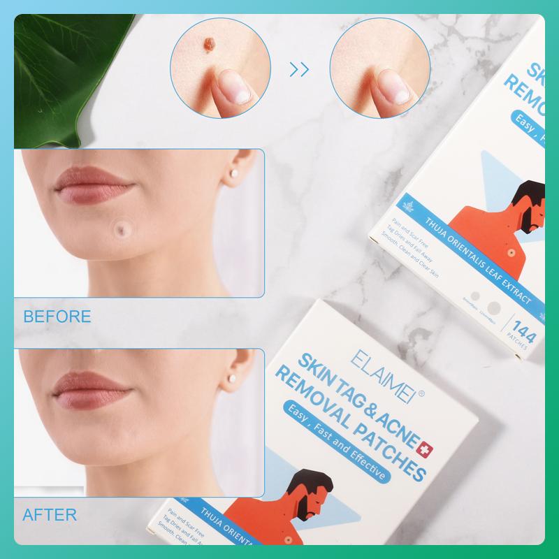 

1 коробка, 144 шт., бирка для кожи и пластыри для удаления прыщей, бирка для кожи, инструменты для удаления наклеек, косметические инструменты