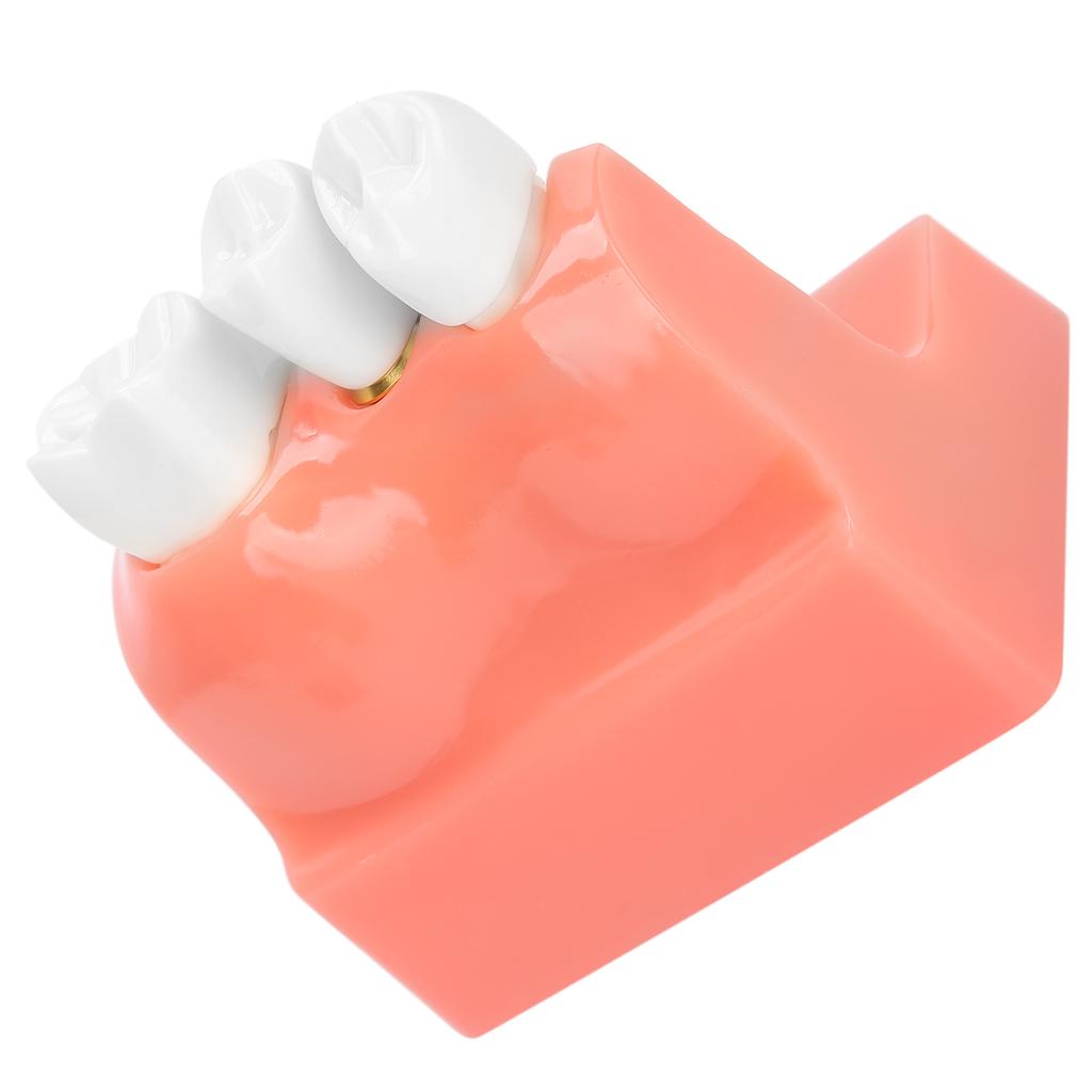 Model zubů Analýza zubního implantátu Demonstrační model korunkového můstku Model zubu