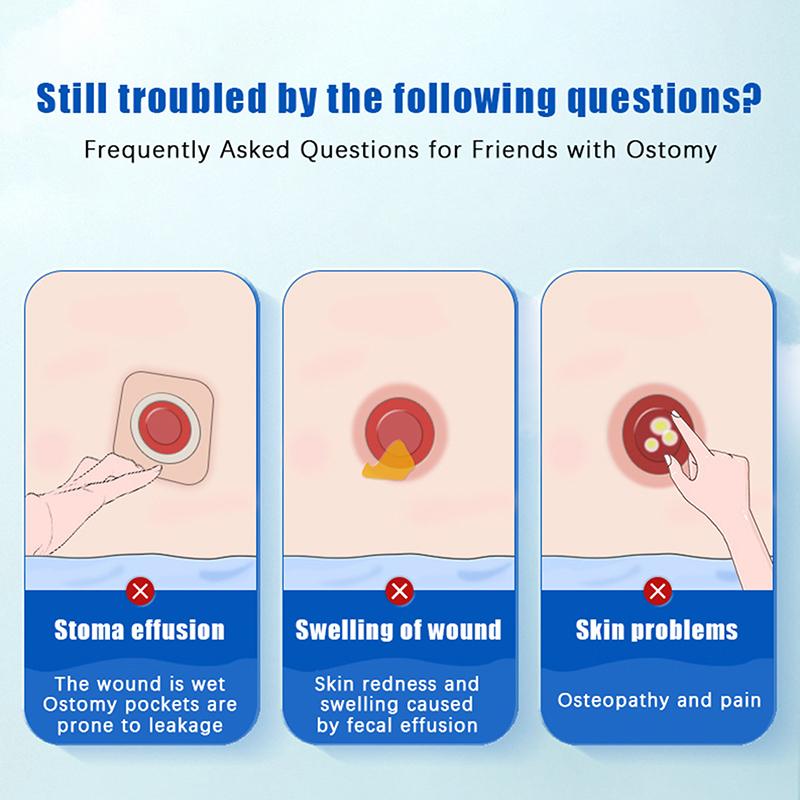 Skin Care Flour Dry Flour Stoma Treatment Medical For Tool Ostomy Accessory Colostomy Bag Supply Protective Care Products