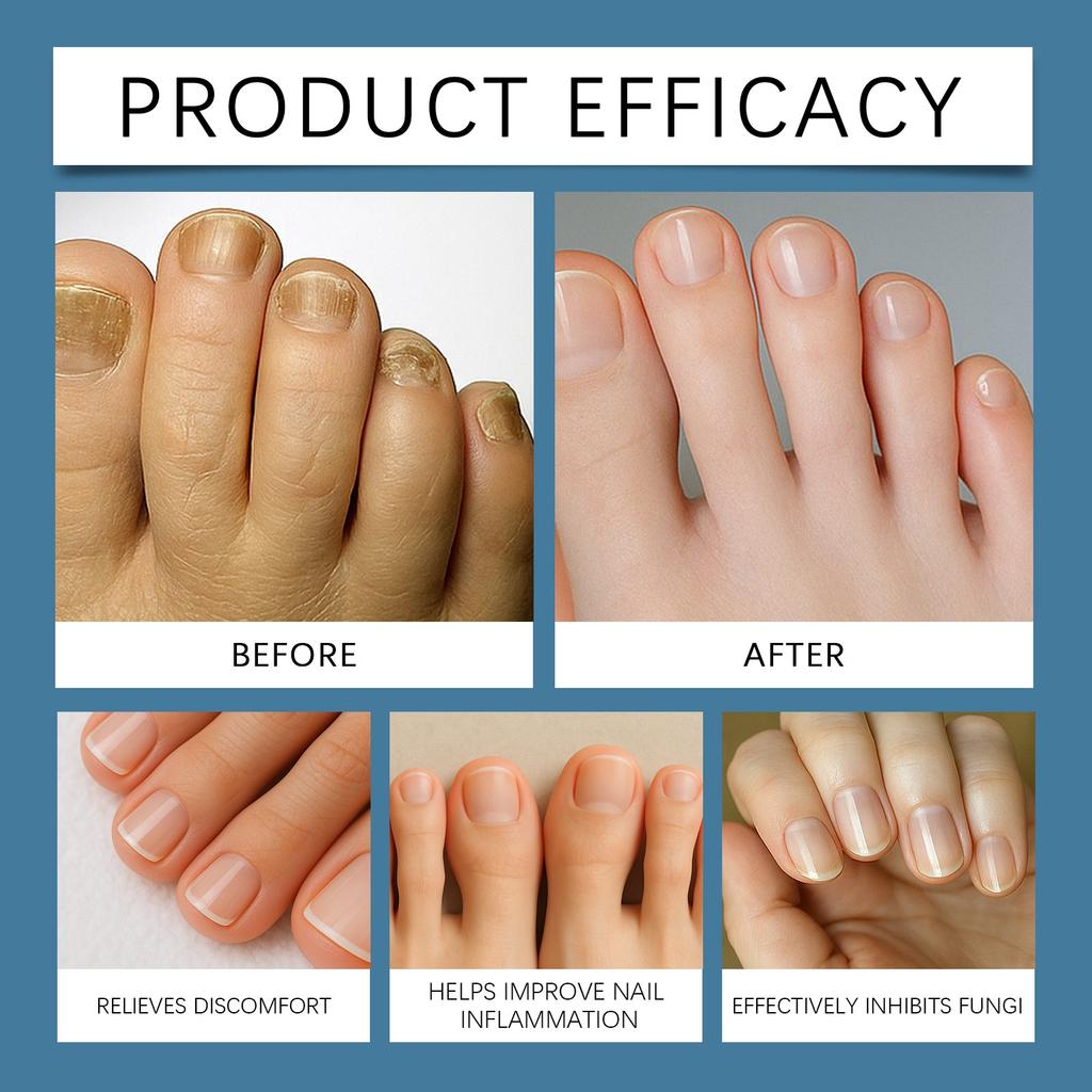 Onychomycosis Care Ointment, Nail Strengthening Cream, Nail Ointment To Strengthen Nails And Reduce Cracking