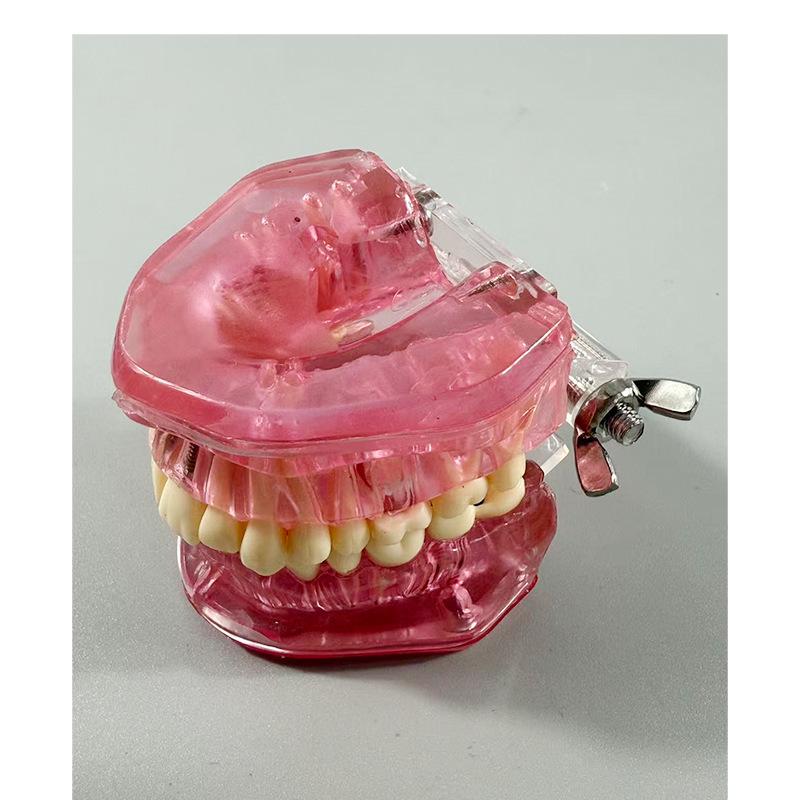 Прозора Знімна Повна Модель Щелепи з М'якими Яснами та Зубами для Підготовки до Імплантації