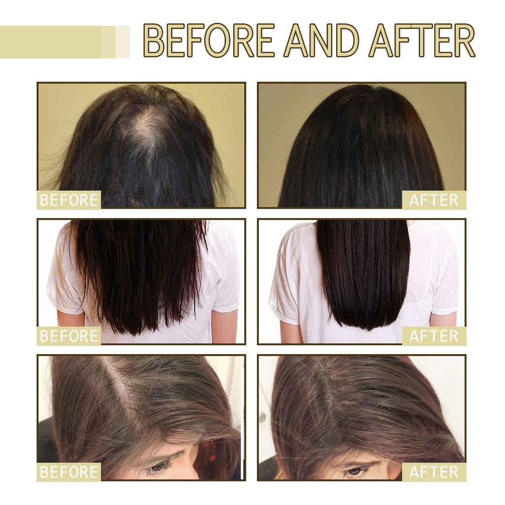 EELHOE Rosemary Oil Grows Hair Loss Treatment Bald Head Hair Regrowth Moisturizing Hair Scalp Massager Rosemary Essential Oil
