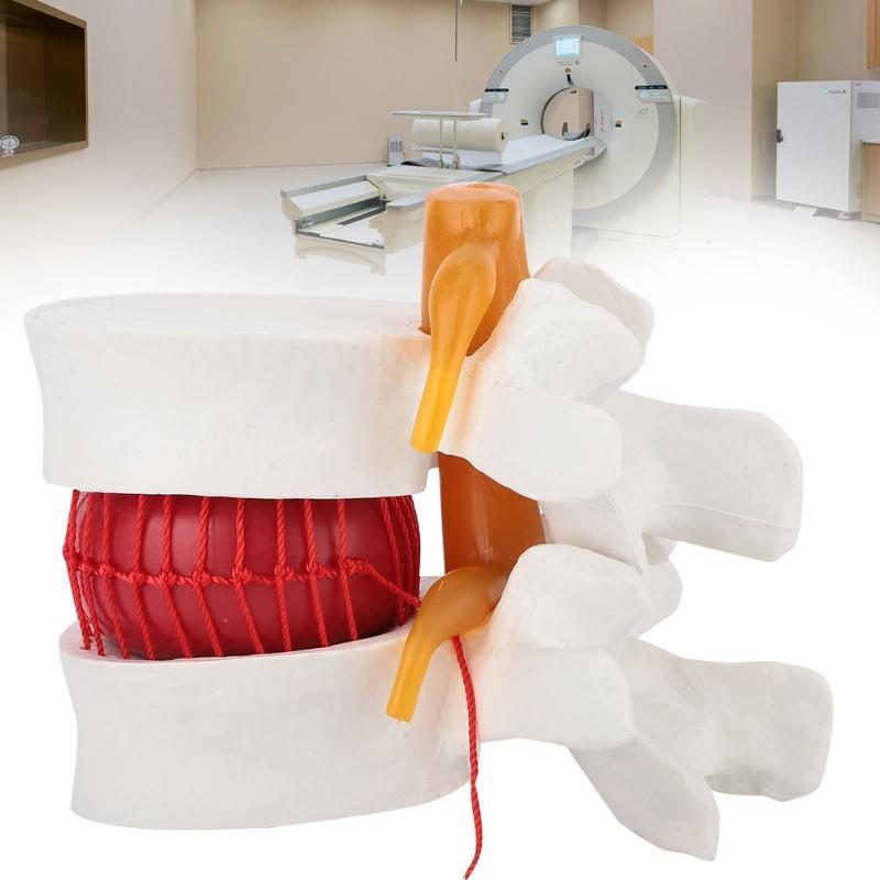 1:1.5 Medical Demonstration Model Of Lumbar Vertebral Spine Human Lumbar Disc Herniation Model