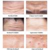 Patch de Gel Anti-rides pour l'élimination des lignes frontales, masque raffermissant, lignes de froncement, soins de la peau du visage, autocollants de traitement, Anti-âge, hydratant