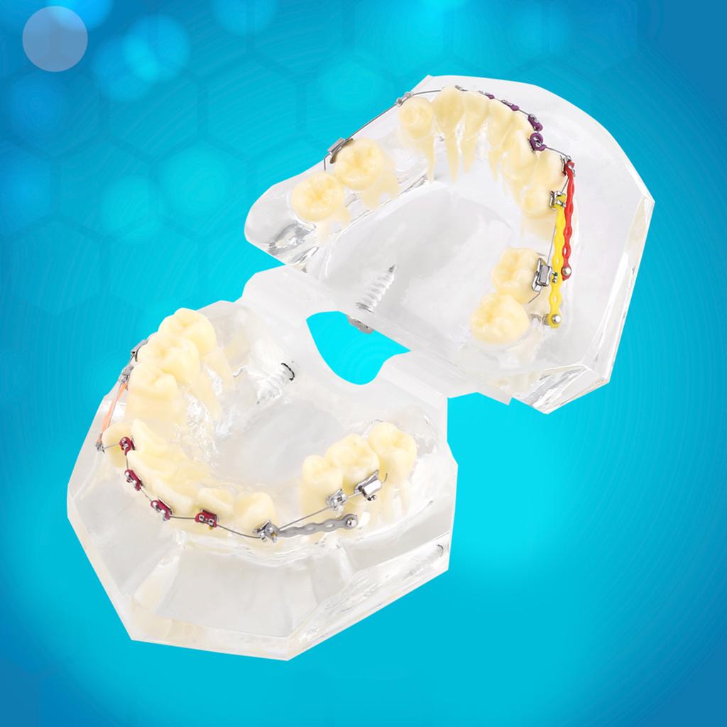 Dental Orthodontic Treatment Malocclusion Study Teeth Model With Wire Chain