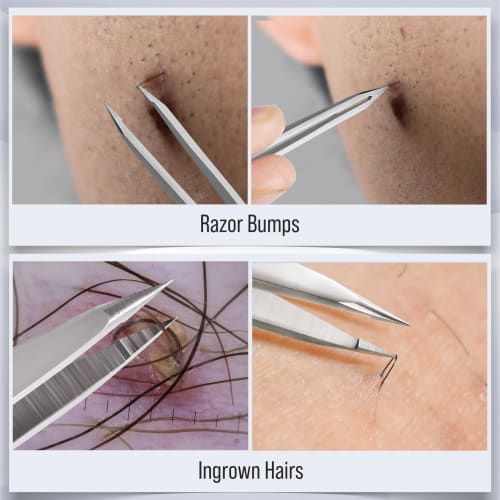 DUROX Ingrown Hair Tweezers / Splint Removal Tweezers / Fine-Tip Tweezers | Ultra-Fine Precision Tip (Pointed/Fine) | Sharp-Tipped Tweezers