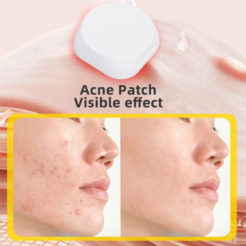 SHOmfrs Factory New Arrival Electronic Acne Patches with Microcurrent & EMS Technology LED Mask Acne Patch