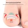 NiTi Alloy Bionic Toenail/Fingernail Corrector for Ingrown Nails