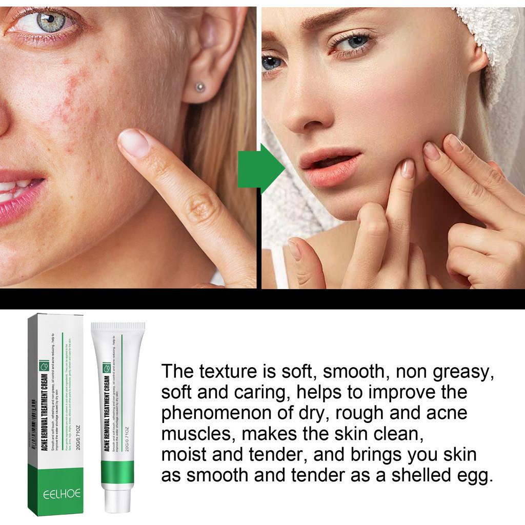 Premium Acne Scar And Spot Cream For Brightening Skin Tone And Moisturizing