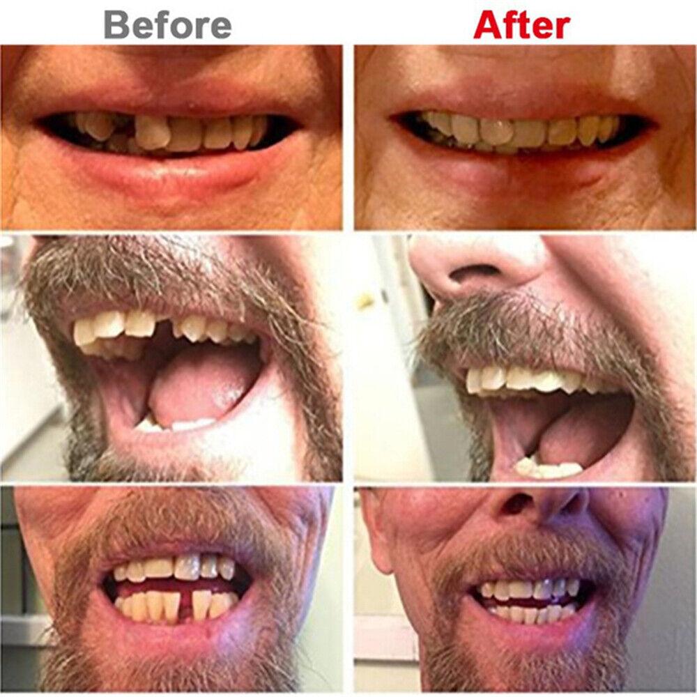 1 Bag/100Pcs Dental Temporary Crown Veneers for Anterior Front Teeth Whitening