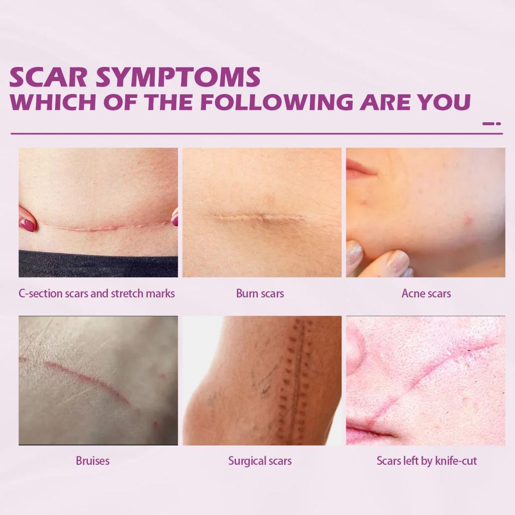 5G/15G/30G/50G/Scar Repair Cream To Lighten Scars, Pregnancy Surgery Scar Repair Skin Smoothing Skin Care Cream