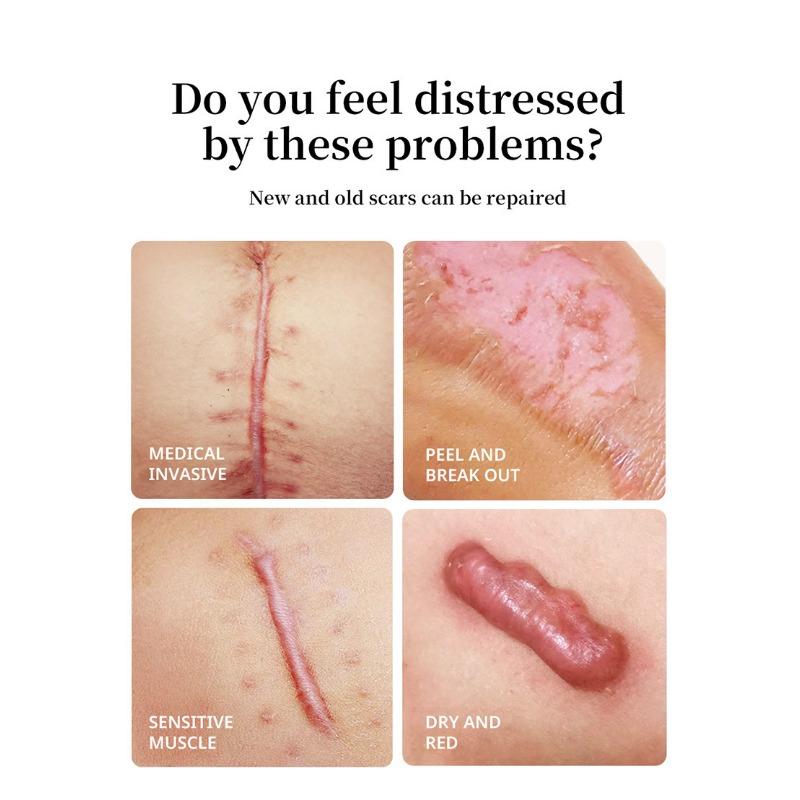 1PC After Burn Fading Skin Ointment