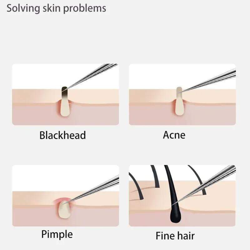 3-8pcs Acne Needle Remove Blackhead Comedone Extractor Tools Stainless Steel Facial Skin Care Tool Pimple Blemish Removal Tools