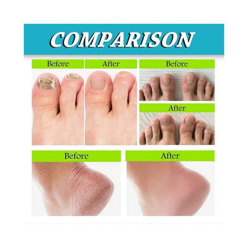 3 Stück Fuß- und Nagelspray, Natürliche und kraftvolle Fußpflege