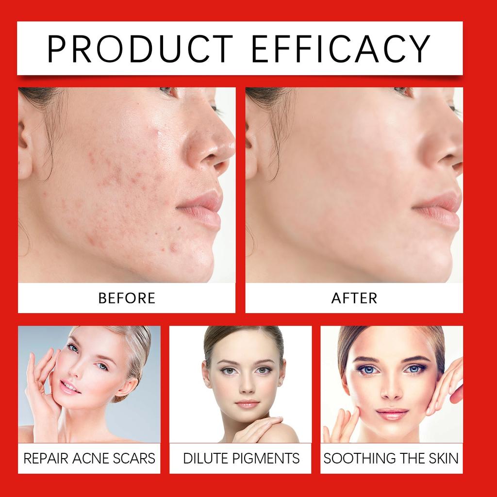 Acne Cream Gently Cleanses Pores, Moisturizes And Smooths The Skin. Moisturizing Care Cream