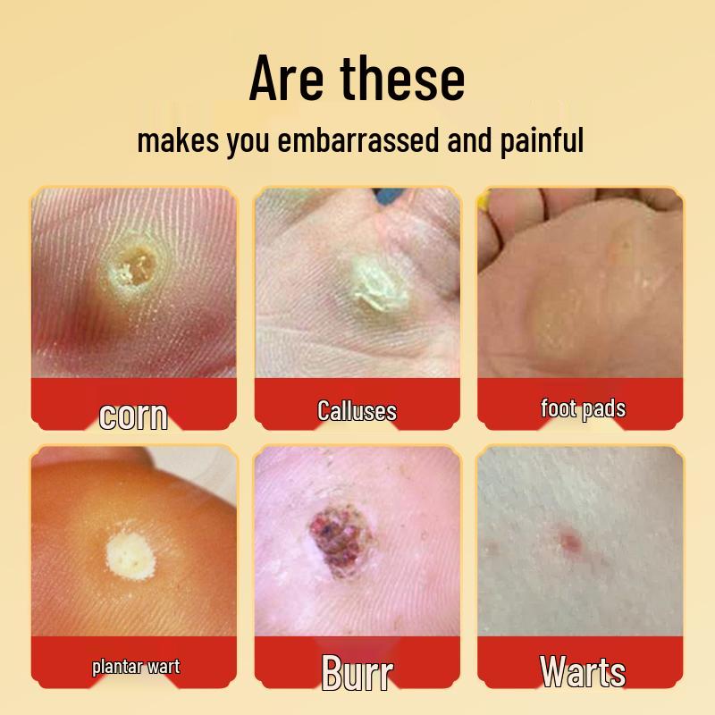 Corn Plaster & Ointment for Foot Calluses: Qingjianling Cream & Jiyoukang Patch