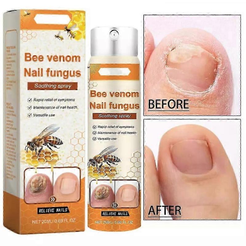 Bee Venom Nail Repair Serum, Nail Care Solution, Natural Bee Venom Nail Care Spray, Ingrown Toenail Care Spray