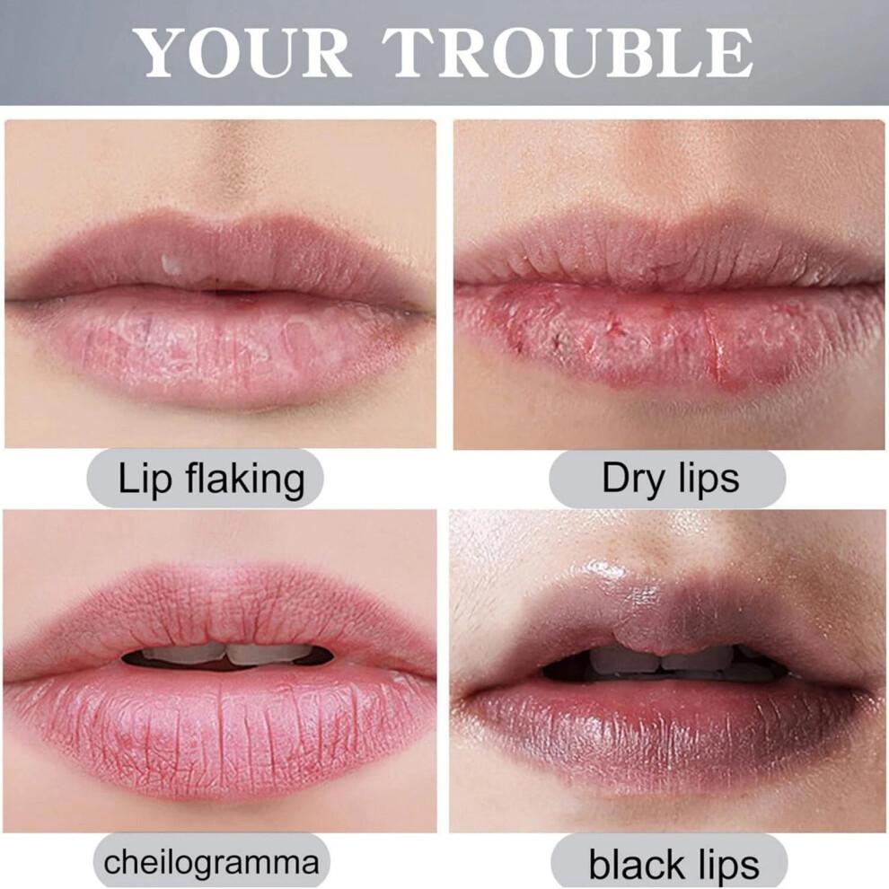 Lip Acne Cream, Fordyce Seeds - Lip Acne, Moisturizes, Improves Dry