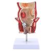 Modèle Anatomique Humain Modèle de Rectum Humain Modèle des Pathologies du Rectum Humain Support Pédagogique pour l'Éducation Scientifique