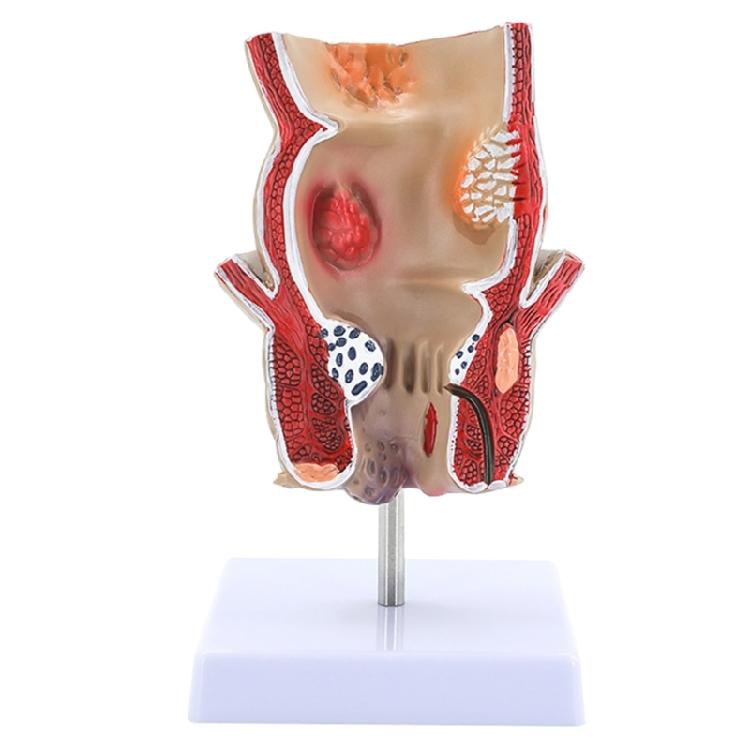 Human Anatomical Model Human Rectum Model Human Pathologies of Rectum Model Teaching Aid for Science Education 1