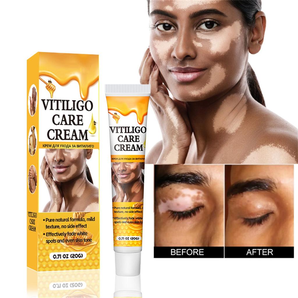Krém na vitiligo, Přírodní zmírnění vitiliga pro kožní vitiligo, Krém pro péči o vitiligo, Redukuje bílé skvrny a zlepšuje pigmentaci kůže, Snadné použití