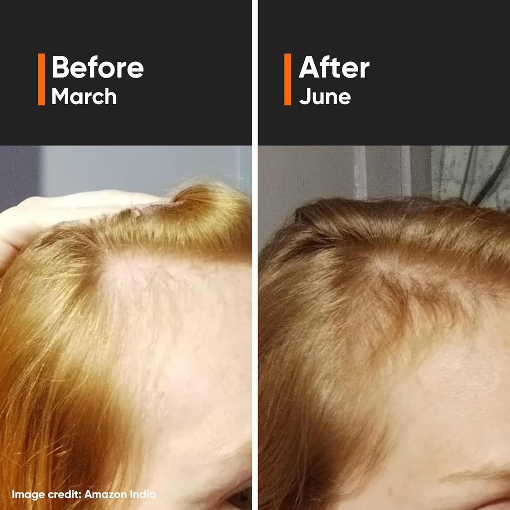 Minimalist Hair Growth Serum 30ml with Capixyl 5%, Redensyl 3%, Procapil 3%, Anagain 3%, Baicapil 4% for Men & Women