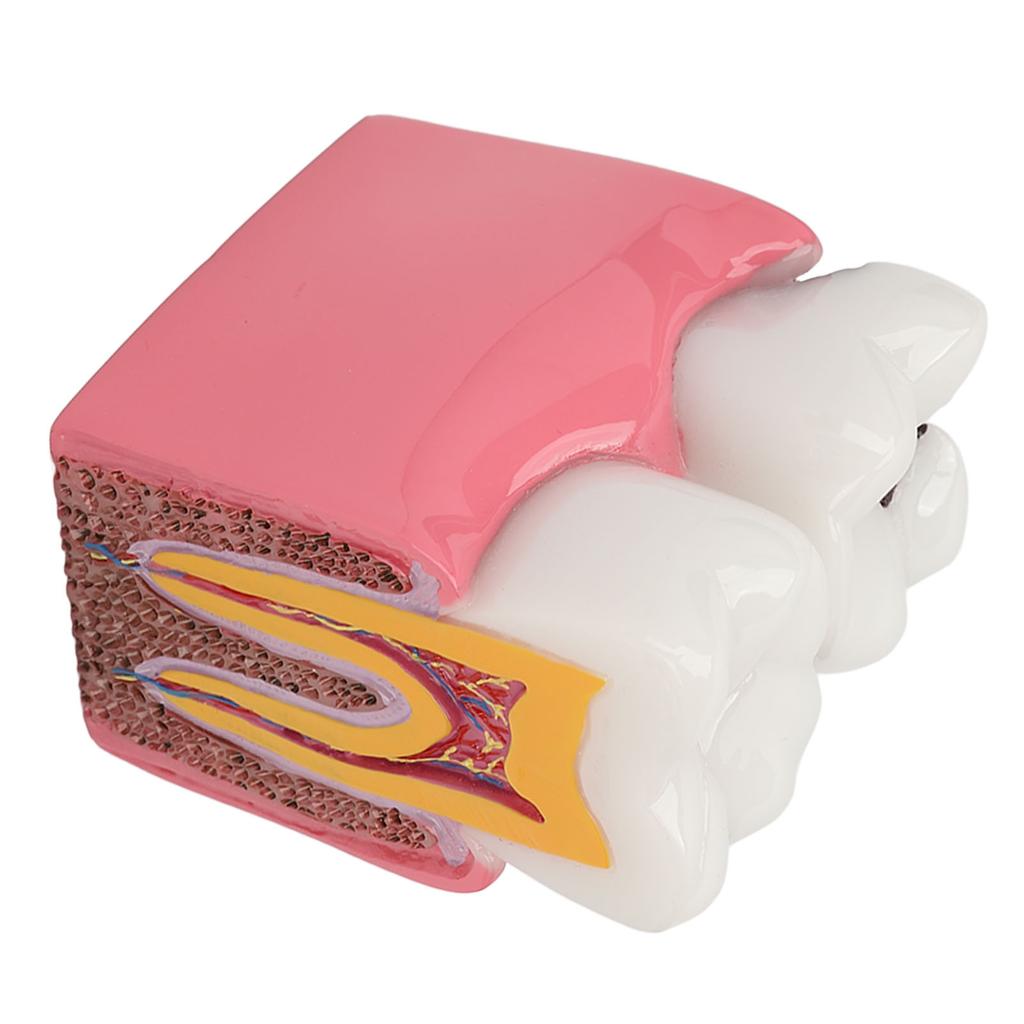 Dental Caries Model Tooth 6X Decay Demonstration Model for Teaching Study Laboratories