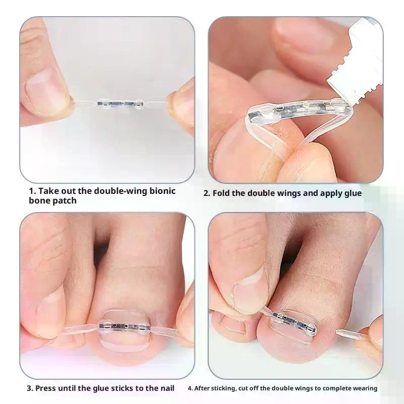 Ingrown Toenail Corrector Tools Pedicure Recover Embed Toe Nail Treatment Professional Ingrown Toenail Straightening Clip Brace