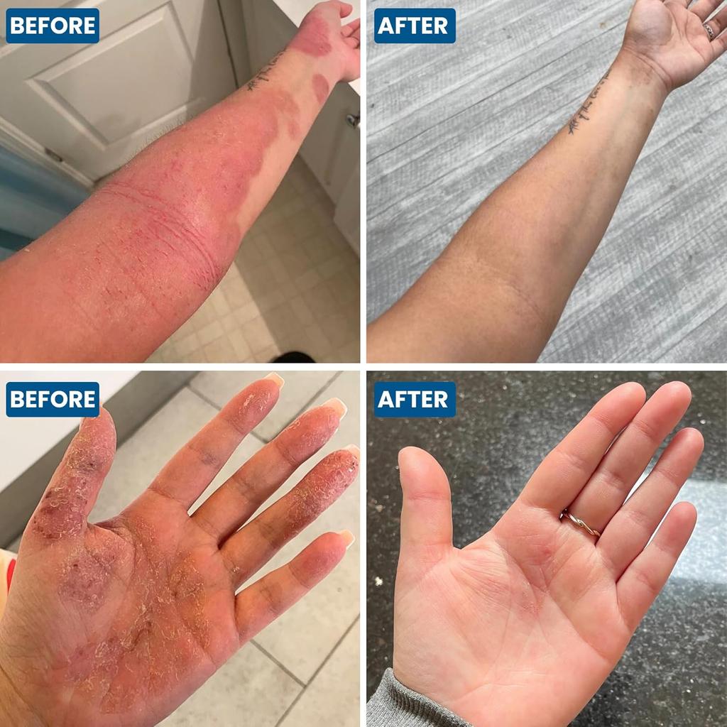 C+ Eczema Cream for Adults - Lotion for Extremely Dry Skin, Inflammation, Redness, Itch Relief & Dermatitis - Manuka Honey & Calendula - Clinically