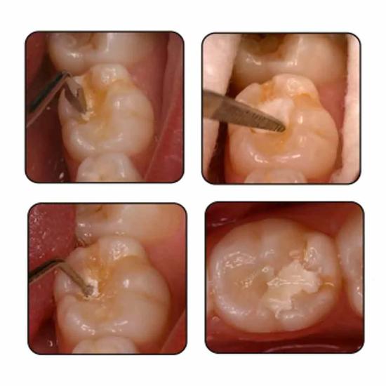 GDC ART Atraumatic Restorative Treatment Instruments