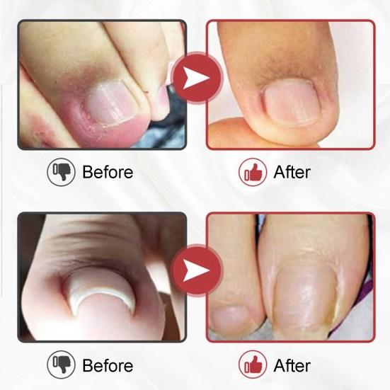 Nail Antibacterial Solution Disinfection Herbal Ingredients Synthetic Toenail Fungal Treatment Liquid for Feet Care